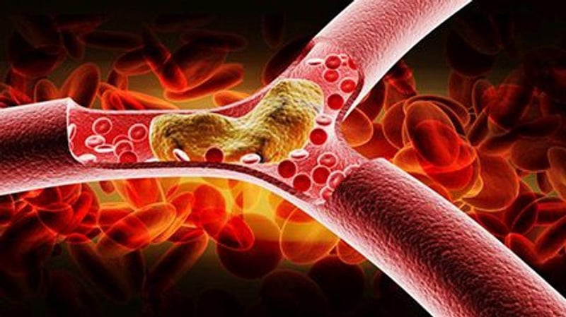 News Picture: Post-COVID Risk for Blood Clot Lasts at Least 6 Months