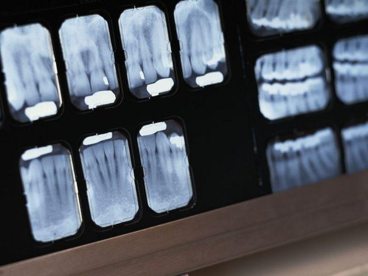  Missing Teeth, Higher Odds for Dementia?