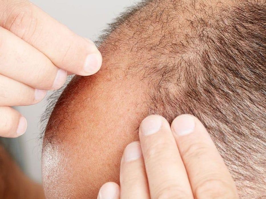 balding man