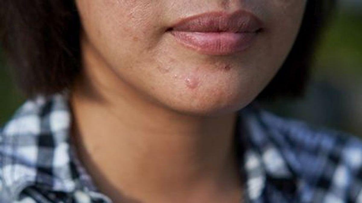 News Picture: Women With Acne Bear Another Burden: Stigma