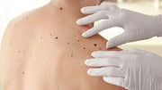 AAD: Risk for Skin Cancer Higher for Adults With Atopic Dermatitis