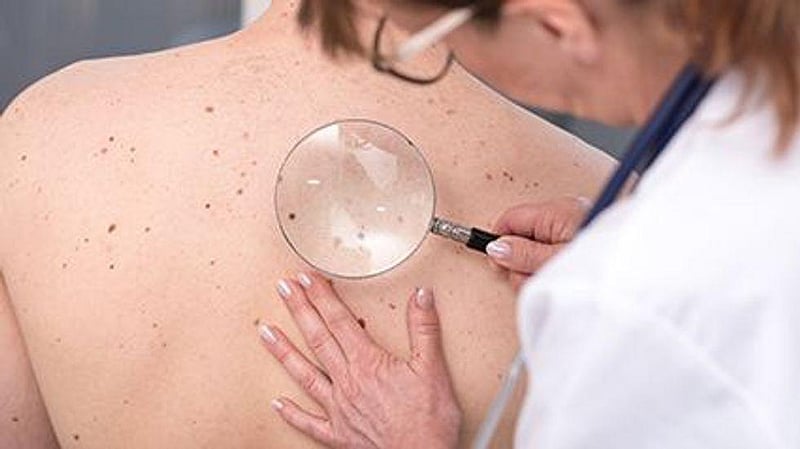 New Drug Might Be Non-Surgical Option for Common Skin Cancers