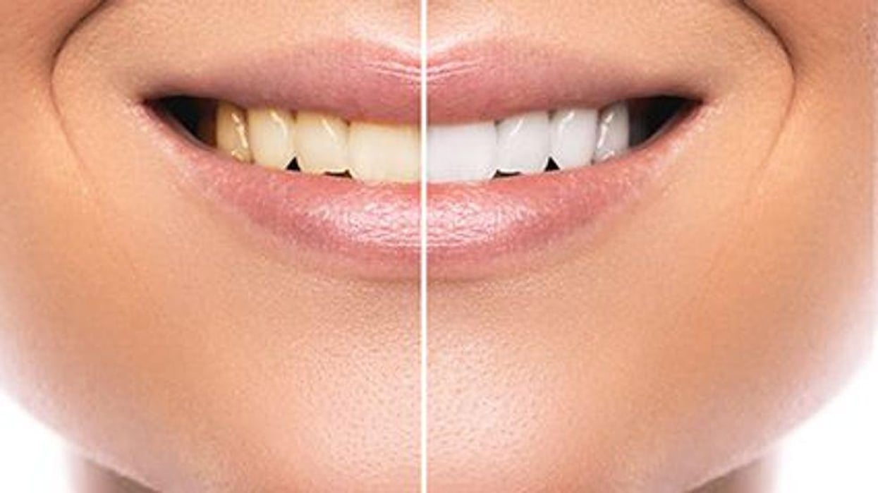 picture showing teeth whitening