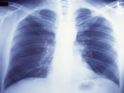 研究:肺部高病毒载量导致致命的COVID-19