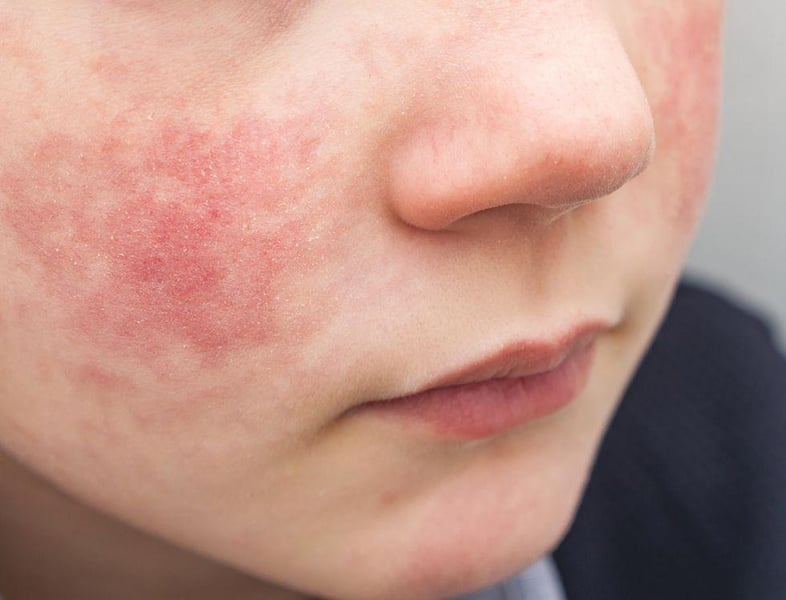 Eczema Can Take Toll on Child's Mental Health