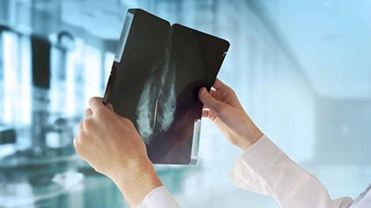 estimating breast cancer