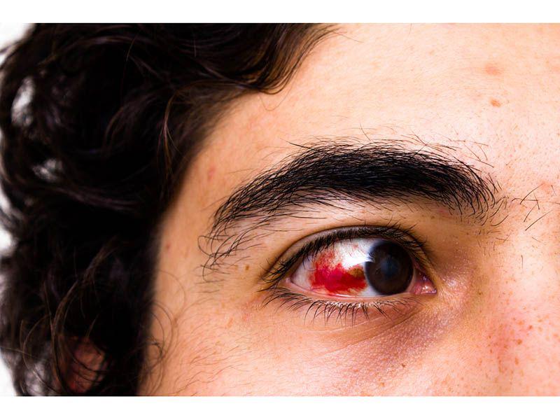 Blood in the Eye - Consumer Health News | HealthDay