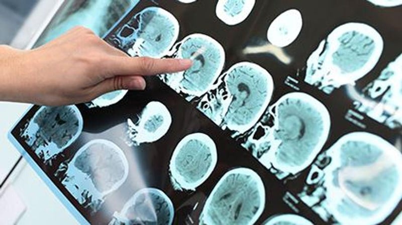 Tracking Key Protein Helps Predict Outcomes in TBI Patients