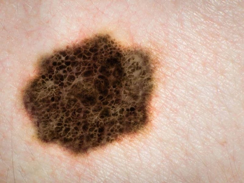 Tips to Checking Your Skin for Skin Cancer