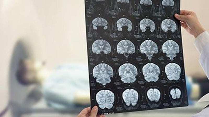 Shape, Size of Brain Arteries May Predict Stroke Risk