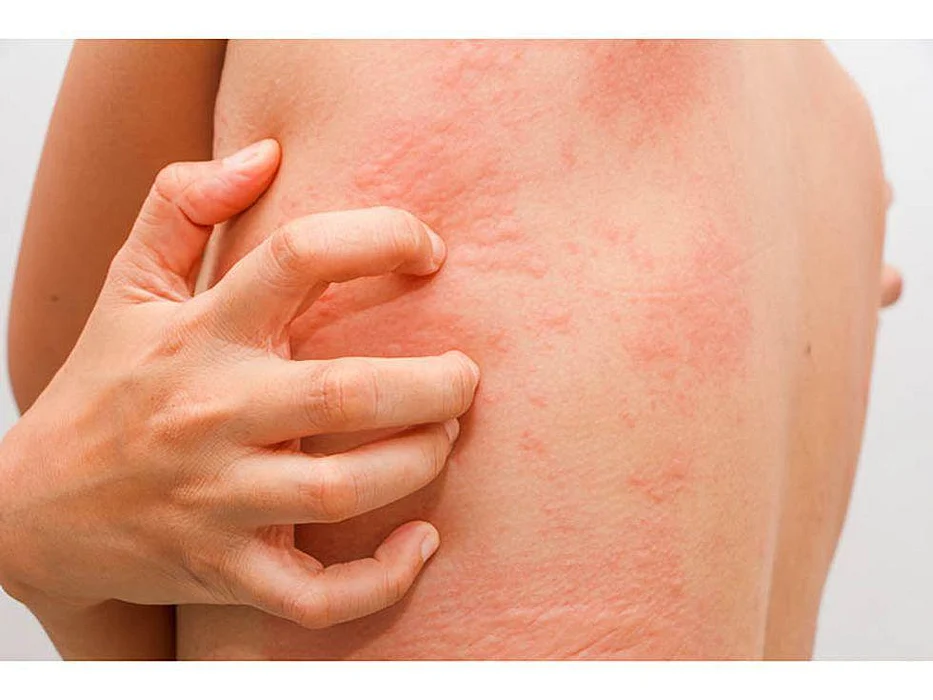 red rash on man's back
