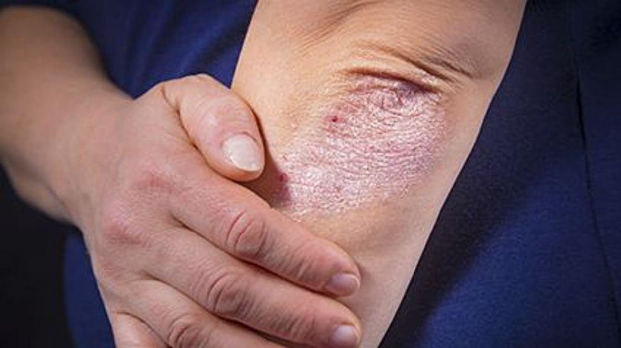 a person showing an elbow with a skin condition called Psoriasis