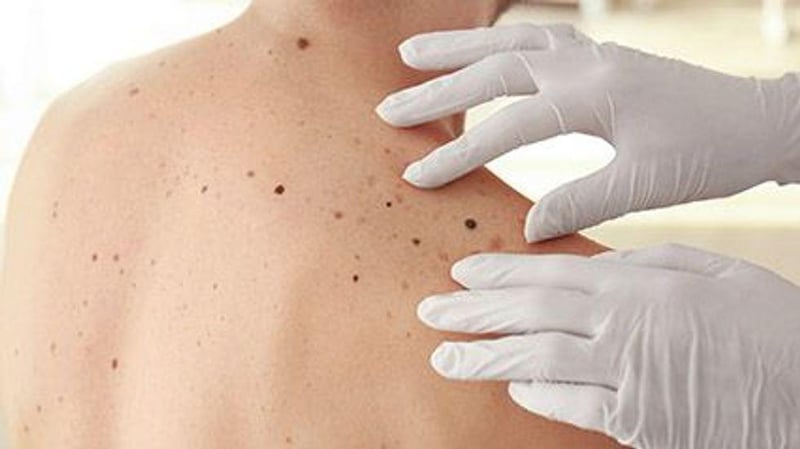News Picture: Skin Tags? Moles? Products Promising to Treat Them Can Do Real Harm