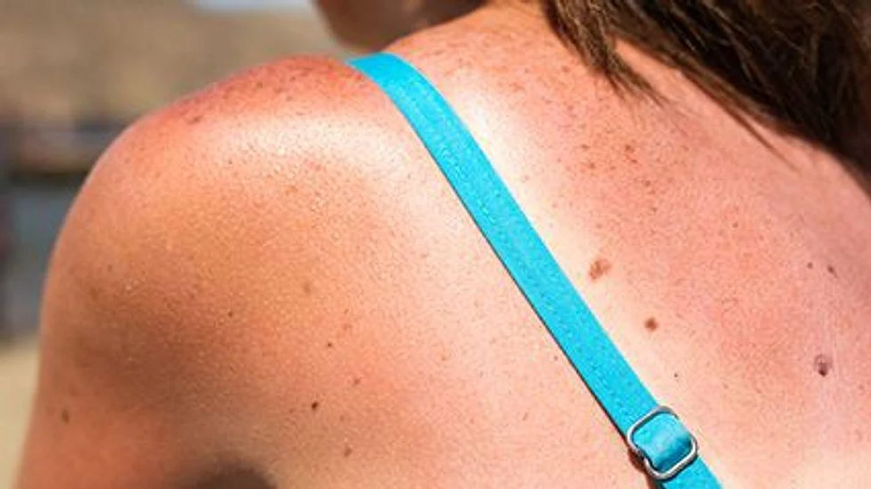 sun exposure