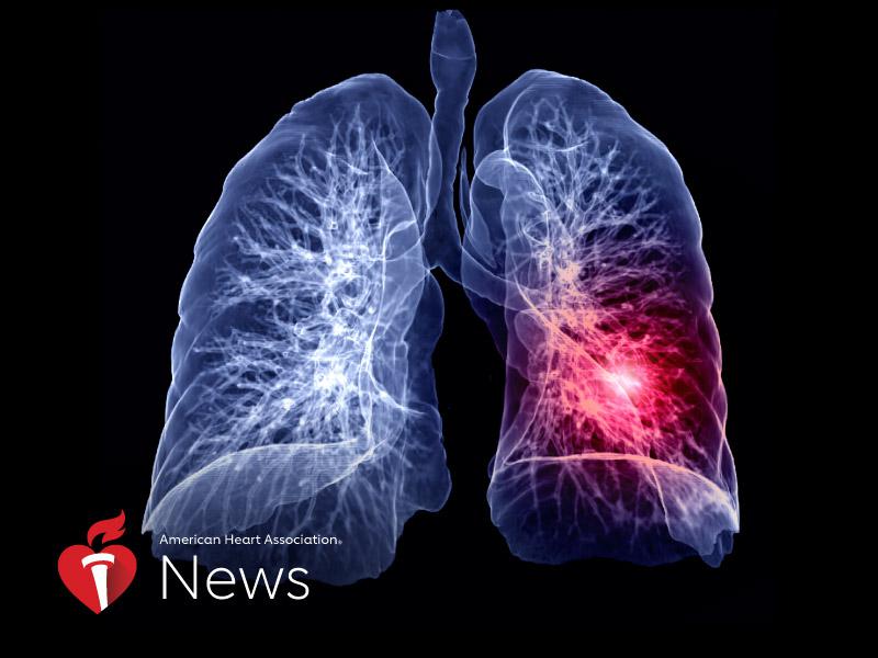 News Picture: AHA News: Pulmonary Embolism Is Common and Can Be Deadly, But Few Know the Signs