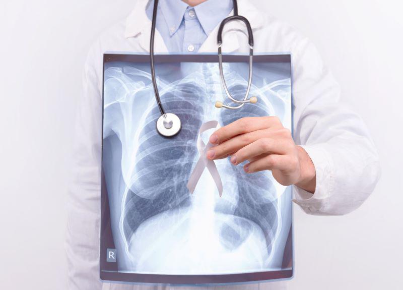 Many Patients Aren't Getting Best Quality Lung Cancer Surgery: Study
