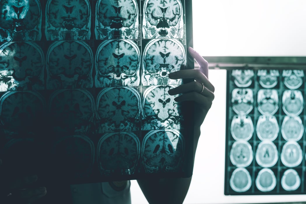 Alzheimer's disease on MRI film