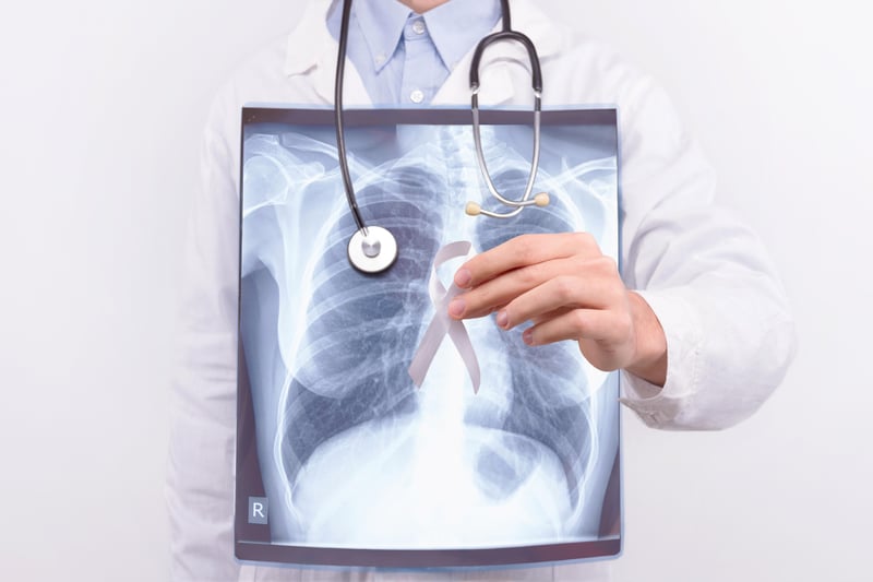 Imagen de noticia: Opdivo podría aumentar la supervivencia de los pacientes con cáncer de pulmón