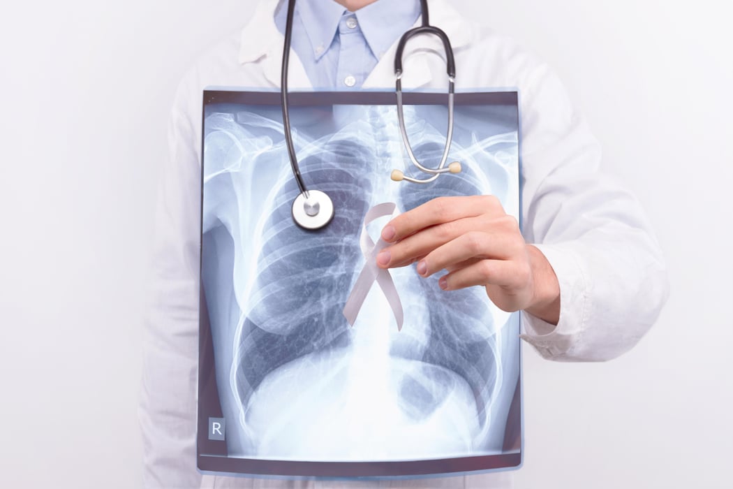 RSNA: 20-Year Survival Shows Lung Cancer Screening Effective