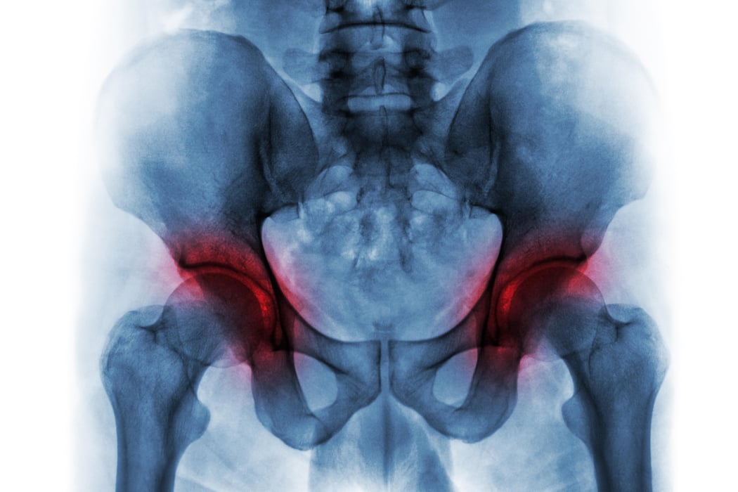 Arthritis both hip . Film x-ray of human pelvis .