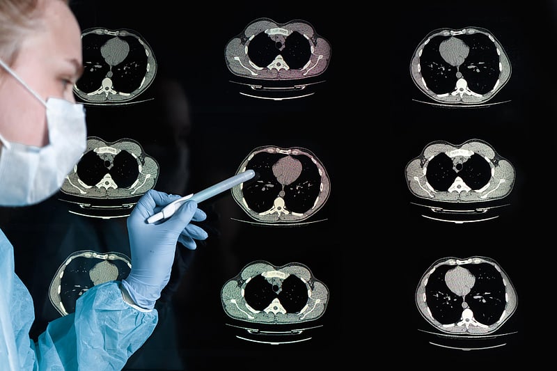 News Picture: Nearly Half of High-Risk Patients Delay Follow-Up After Lung Cancer Screening