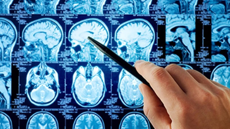 COVID-19 May Cause Long-Term Brain Changes in Some Patients, Study Finds