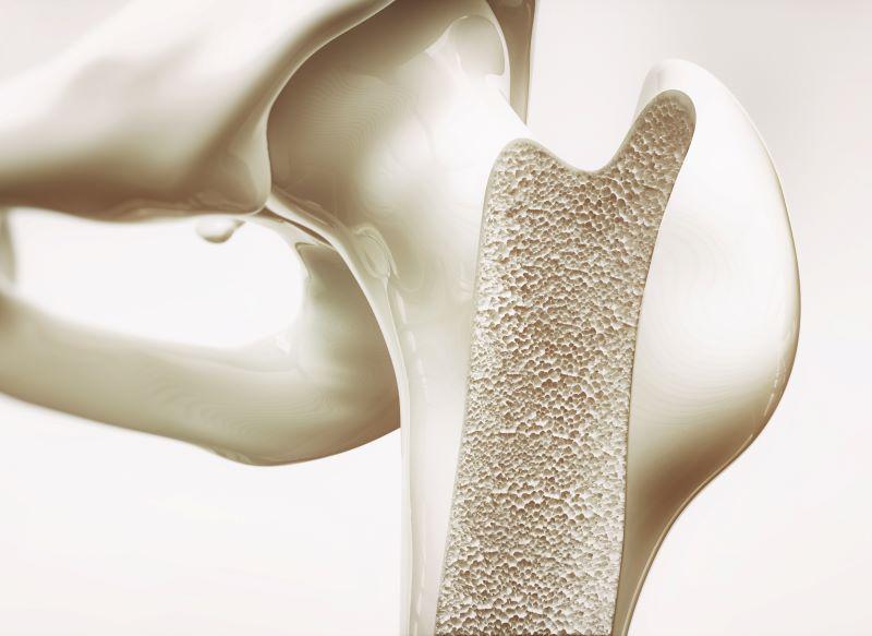Bone Up on Osteoporosis & Your Bone Health