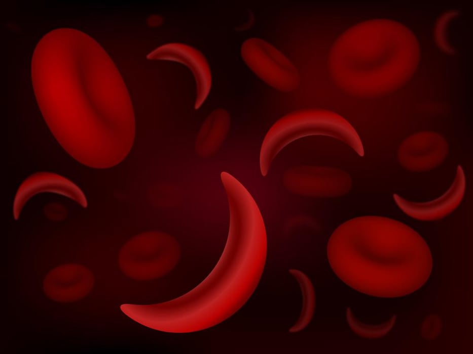 Sickle Cell Anemia (Children)
