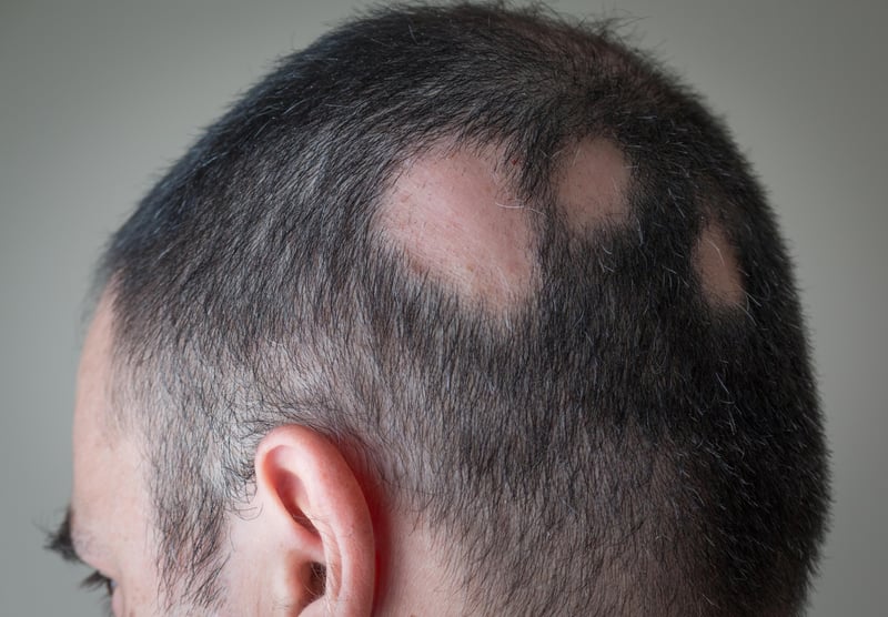 News Picture: FDA Approves First Pill to Treat Severe Alopecia