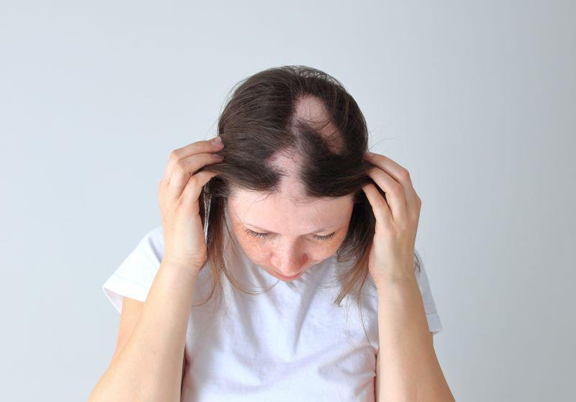News Picture: A New Treatment Option for a Form of Sudden Hair Loss