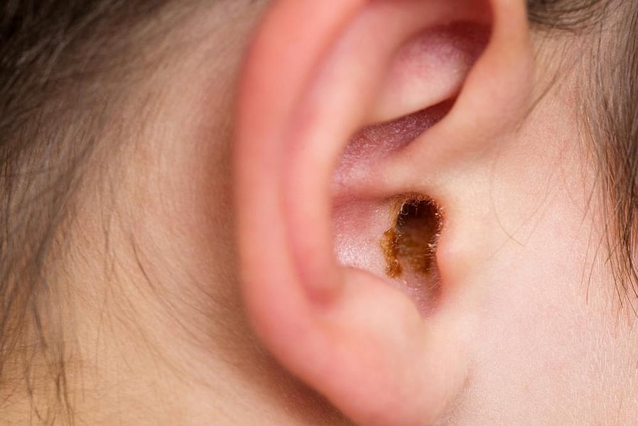 earwax-problems-consumer-health-news-healthday