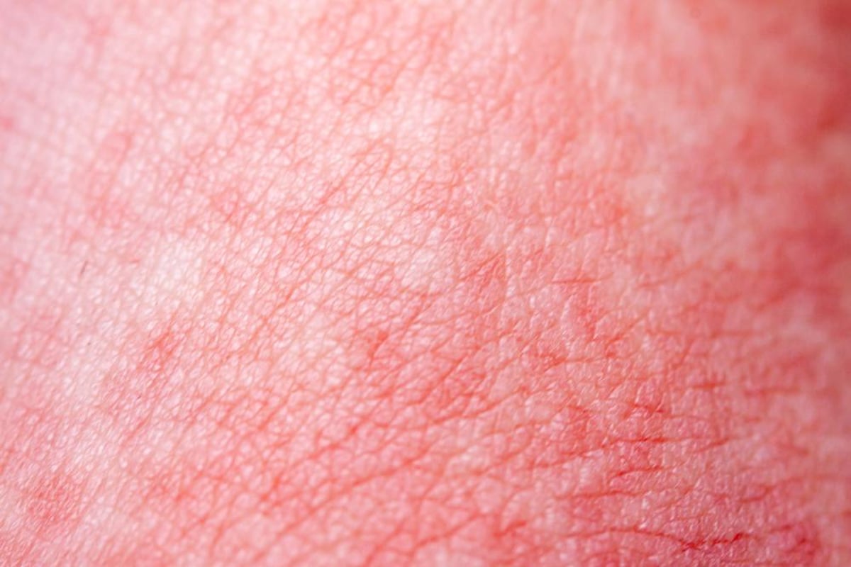 Scarlet Fever: Symptoms, Prevention, Treatment, And More