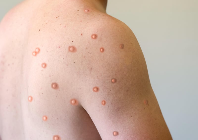 Monkeypox May Sometimes Spread Through the Air