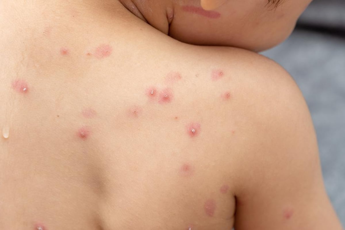 Chickenpox in outlet children