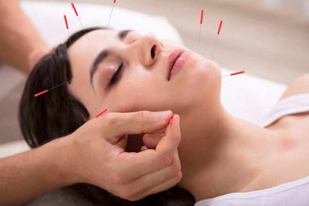 Acupuncture Reduces Frequency of Chronic Tension-Type Headaches