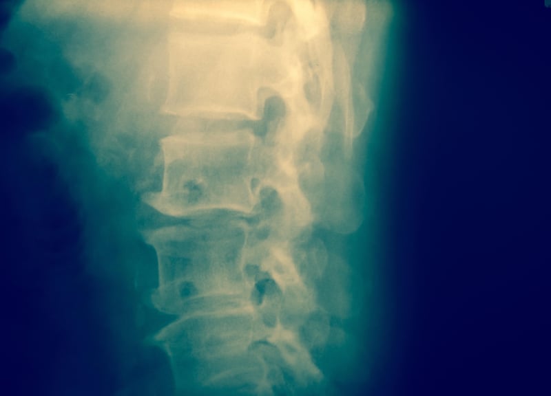 Could an Experimental Cancer Drug Help Treat Spinal Injury?