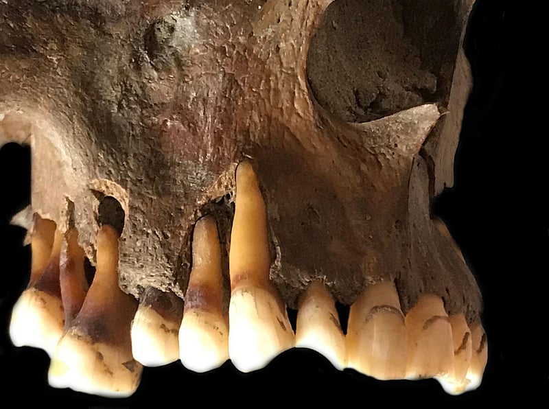 News Picture: Ancient DNA Points to Oral Herpes' Beginnings