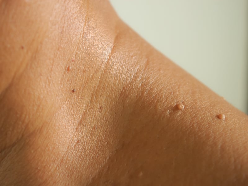 News Picture: FDA Warns Amazon, Other Vendors About Sale of Skin Tag Removal Products