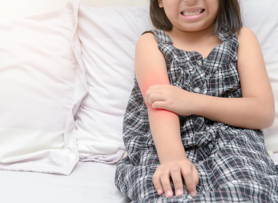 child eczema itch