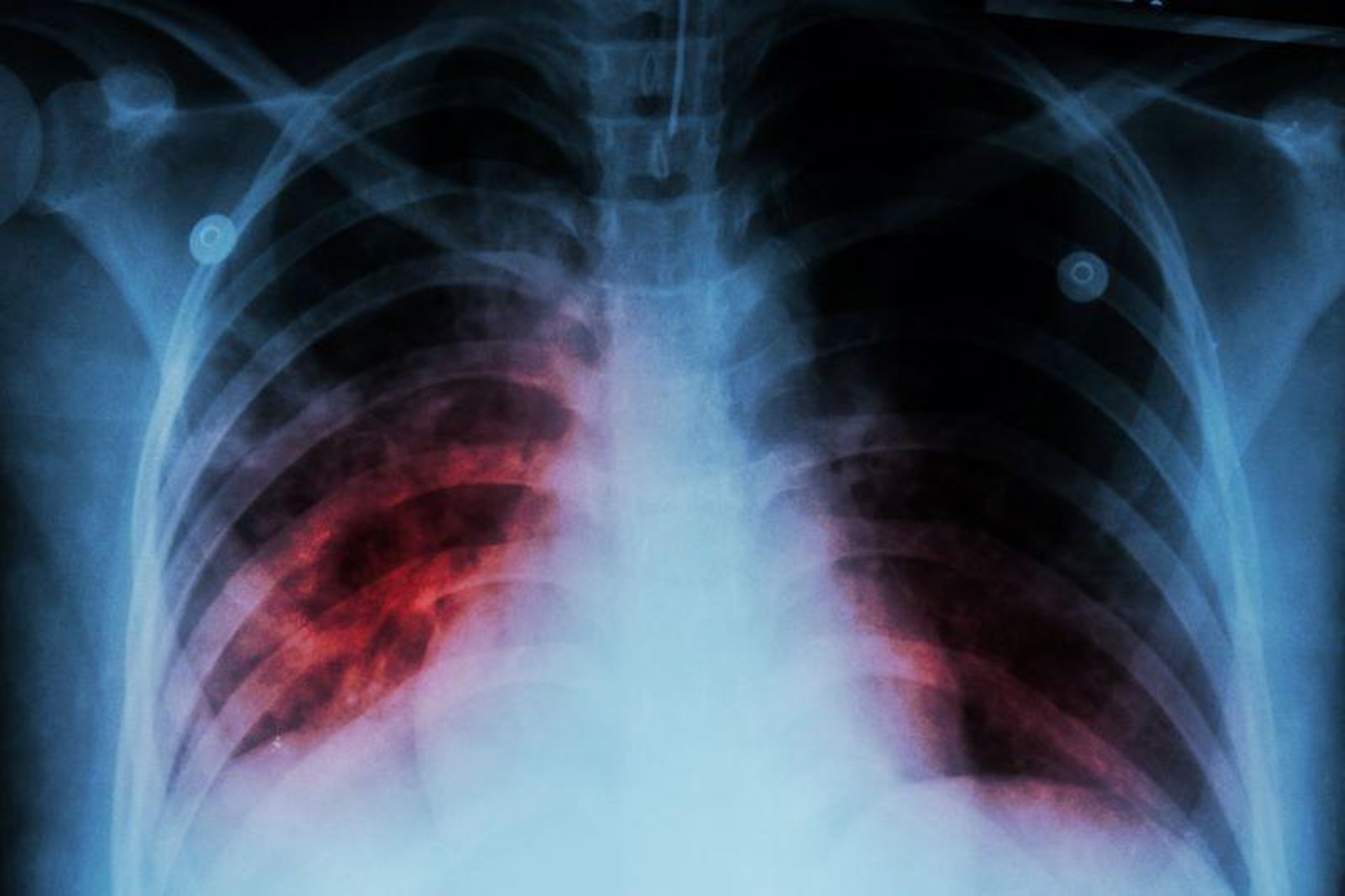 News Picture: U.S. Tuberculosis Cases Rose in 2022: CDC