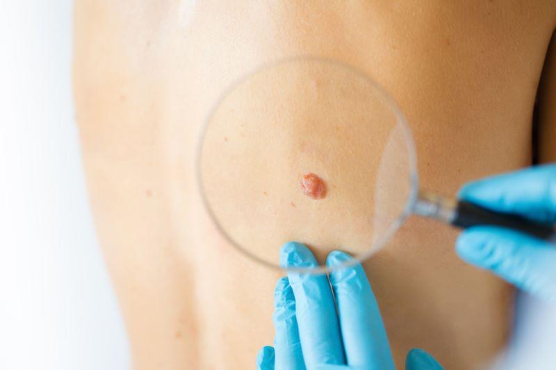 Melanoma: What It Is, Causes, Types, Symptoms & Treatments