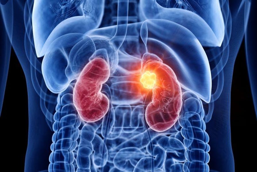 Cabozantinib Plus Nivolumab and Ipilimumab Increases PFS in Renal Cell ...