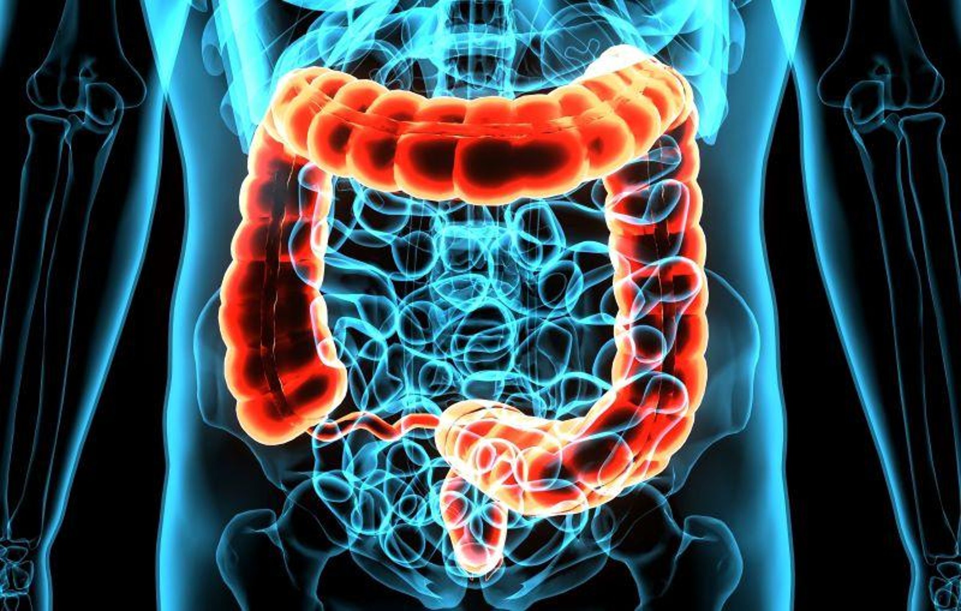 News Picture: Could Microbiome Changes Explain Rise in Colon Cancer Among the Young?