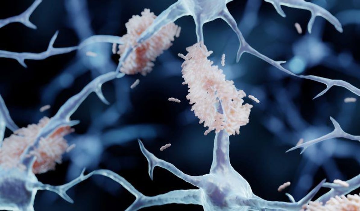 amyloid plaque forming between neurons in Alzheimer disease