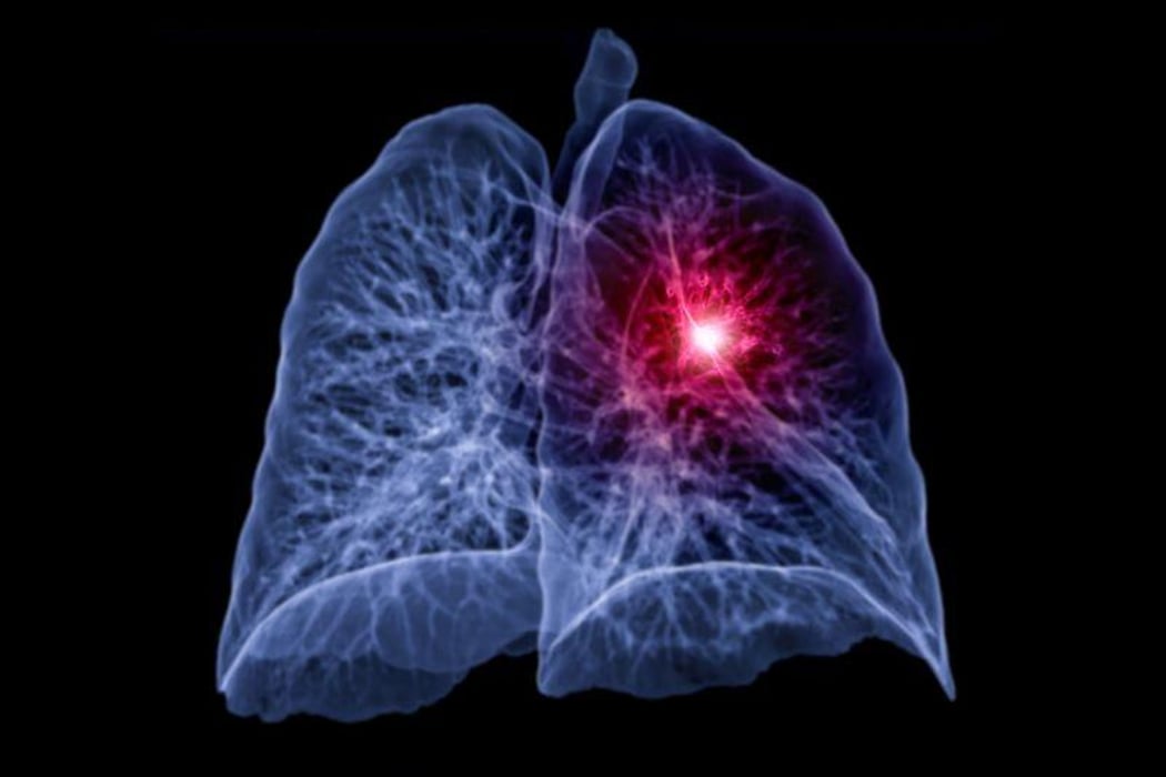 lung imaging
