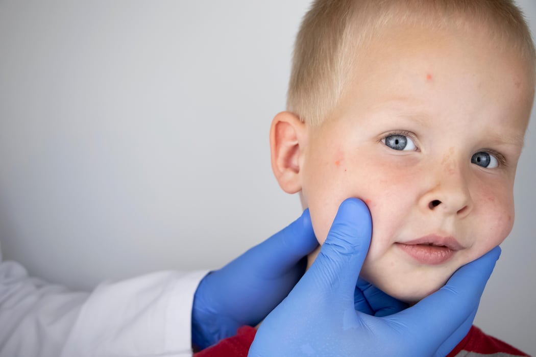 young boy with measles