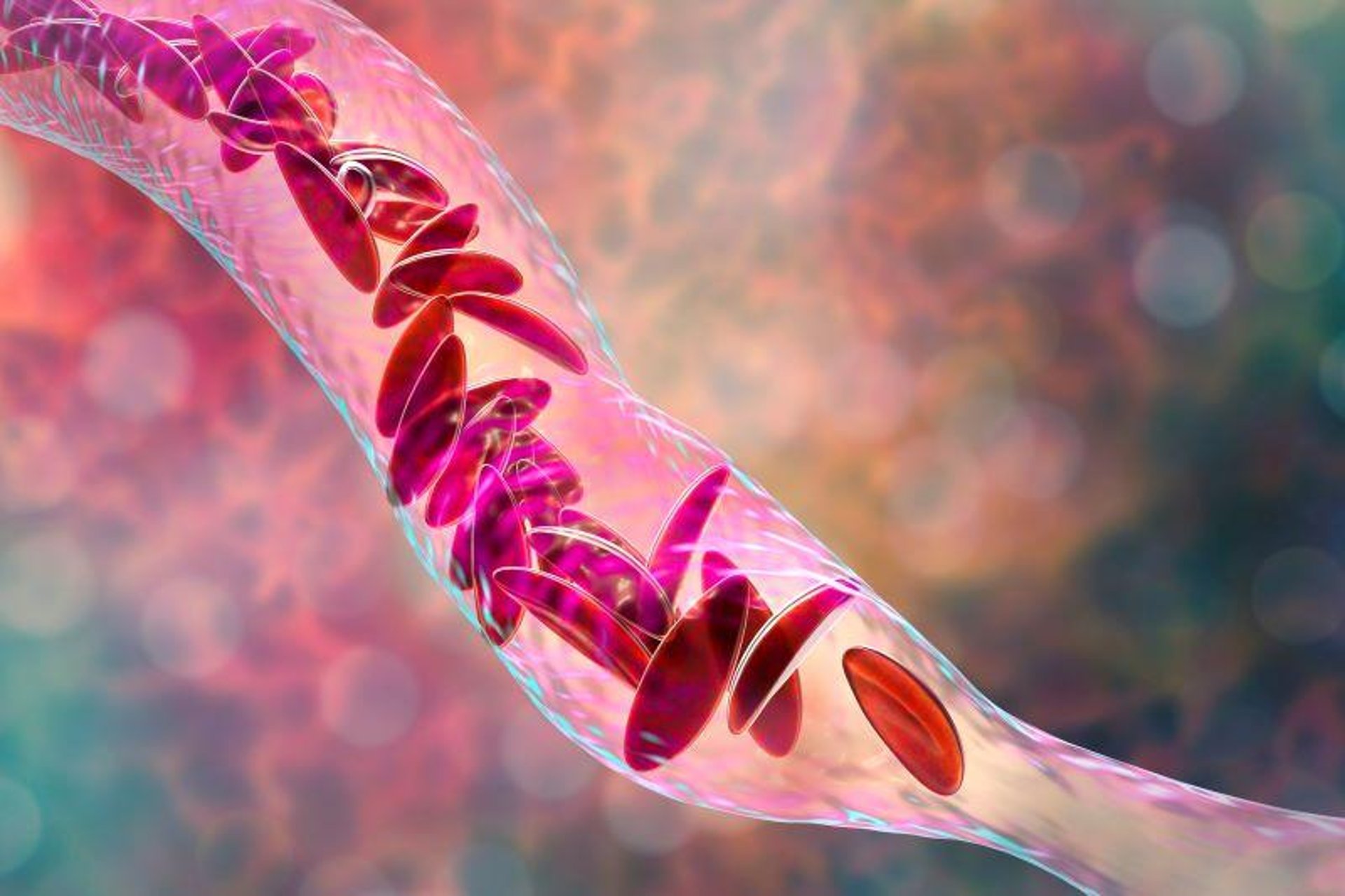 News Picture: Gene-Tweaked Stem Cells Offer Hope Against Sickle Cell Disease