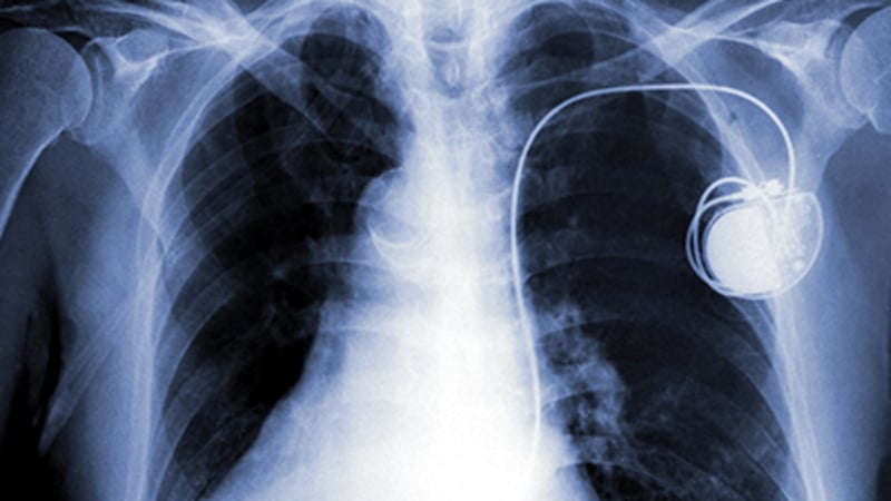 Could Your Smart Watch Interfere with Your Pacemaker?