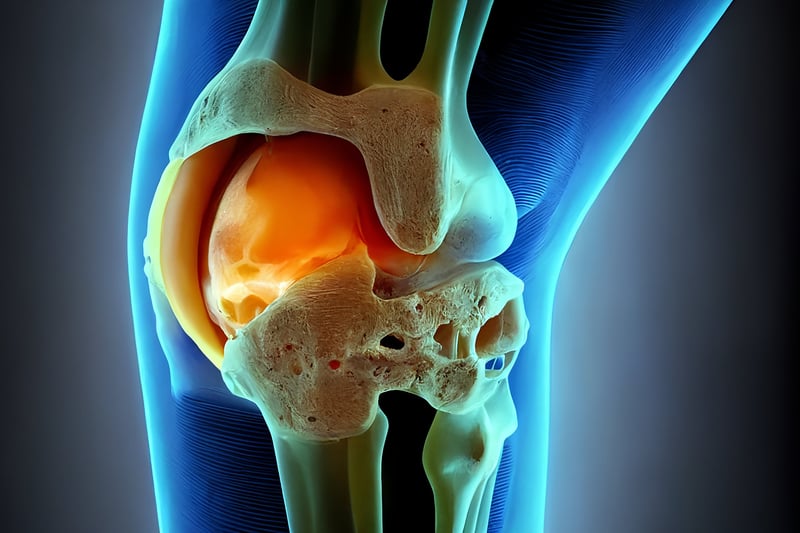 Knee Replacement More Challenging in People With Sickle Cell