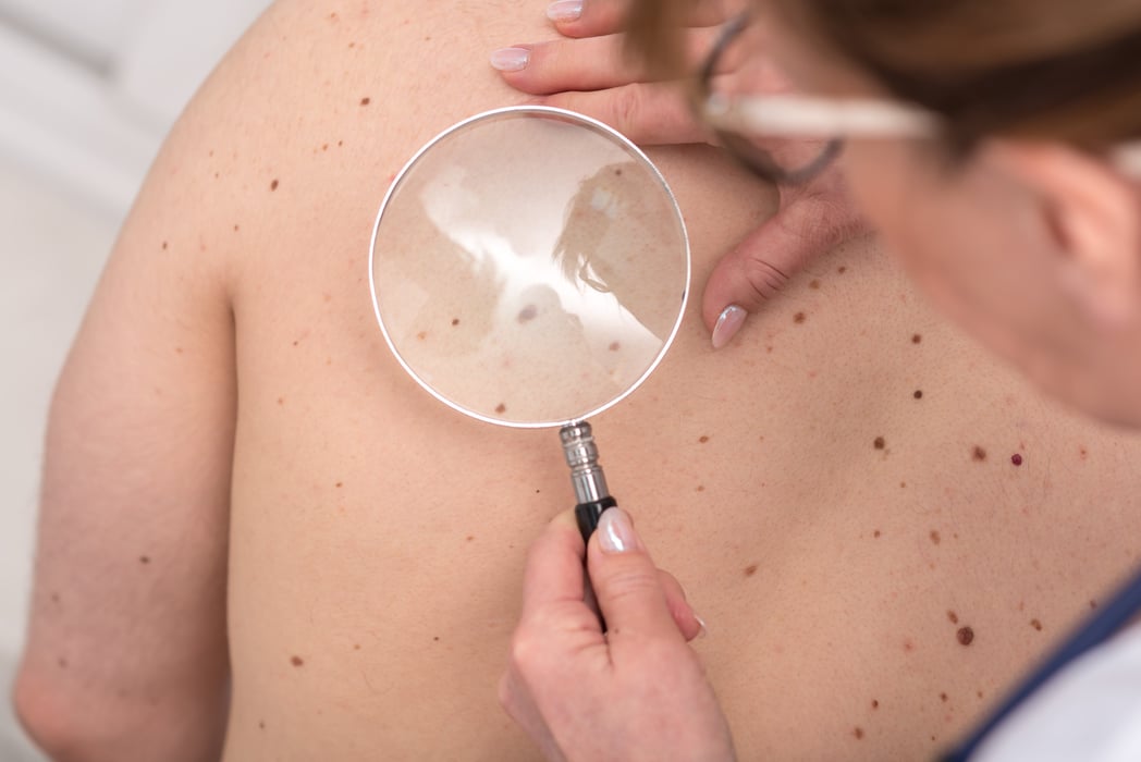 female dermatologist examining patient back for melanoma with a magnifying glass